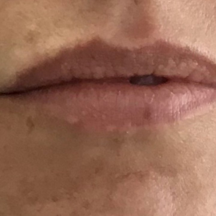 Antes - Preenchimento Labial - Est&eacute;tica Batel Curitiba