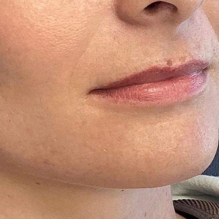 Antes - Caso 10 Preenchimento Labial