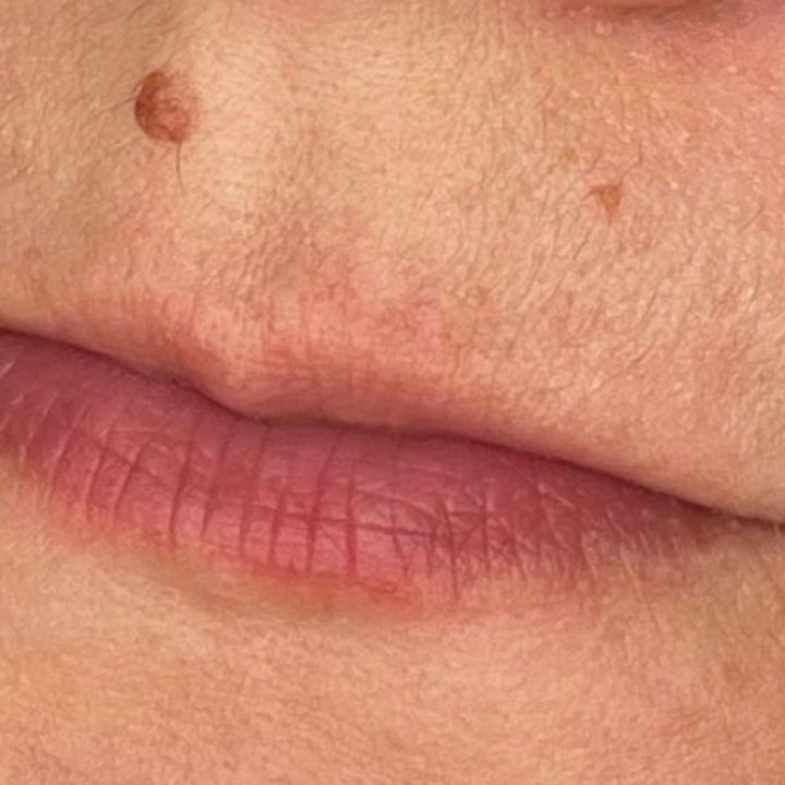 Antes - Caso 11 Preenchimento Labial