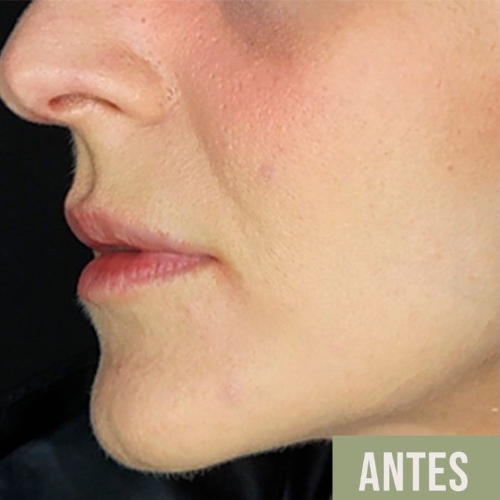 Antes - Caso 12 Preenchimento Labial