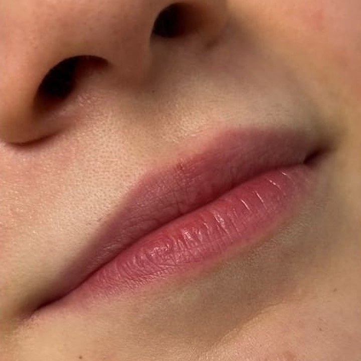 Antes - Preenchimento Labial - Est&eacute;tica Batel Curitiba
