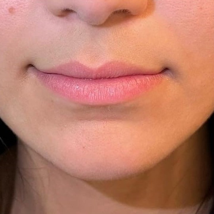 Antes - Caso 14 Preenchimento Labial