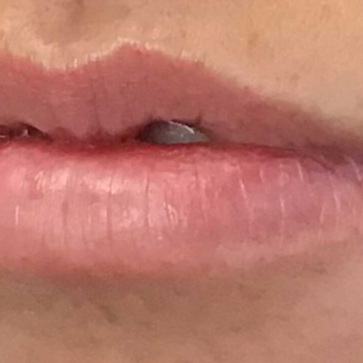 Antes - Caso 15 Preenchimento Labial