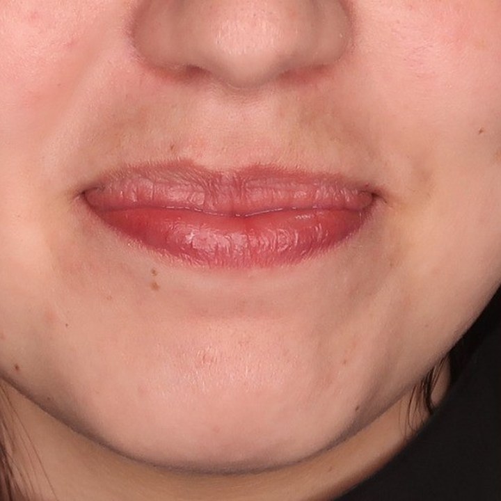 Antes - Caso 16 Preenchimento Labial