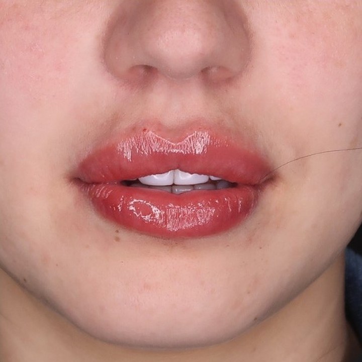 Depois - Caso 16 Preenchimento Labial