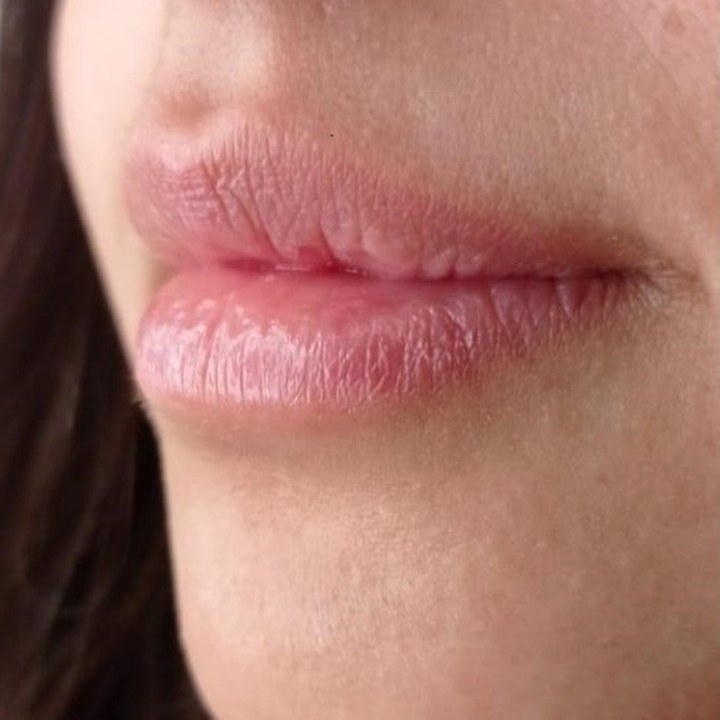 Antes - Caso 17 Preenchimento Labial