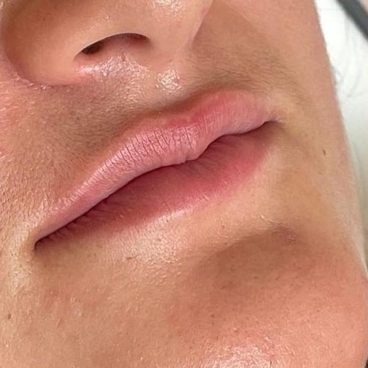 Antes - Caso 18 Preenchimento Labial