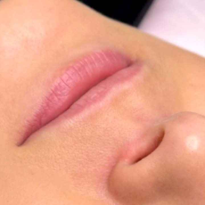 Antes - Caso 19 Preenchimento Labial