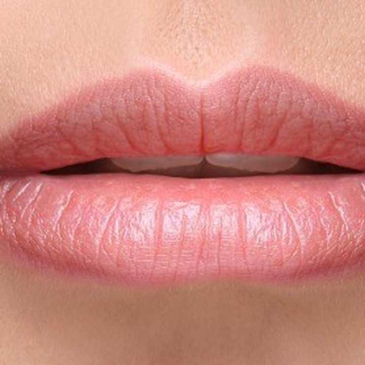 Antes - Preenchimento Labial - Est&eacute;tica Batel Curitiba