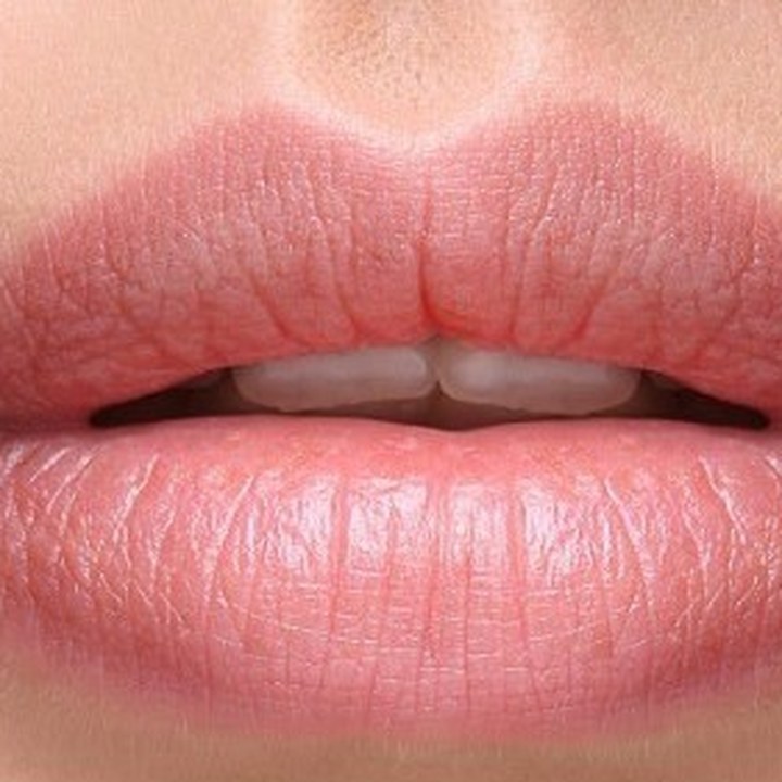 Depois - Preenchimento Labial - Est&eacute;tica Batel Curitiba