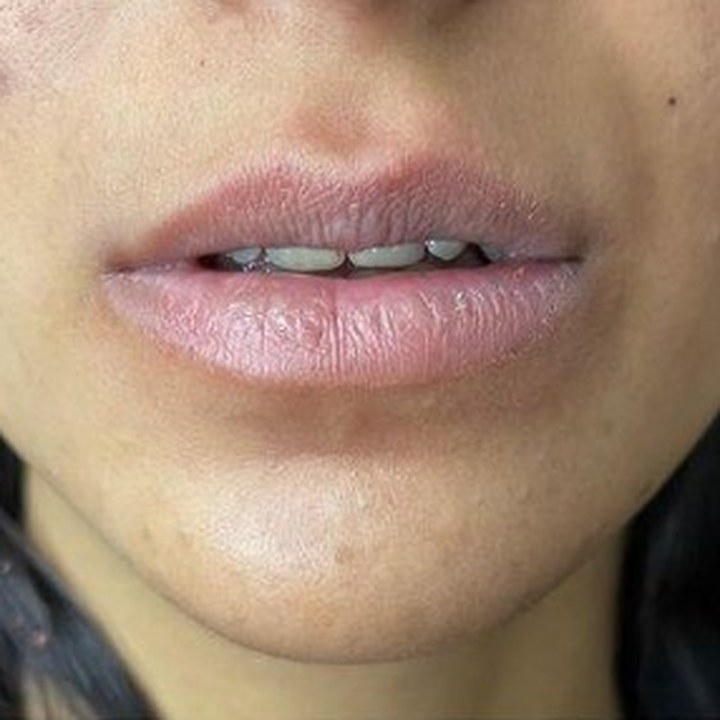 Antes - Caso 21 Preenchimento Labial