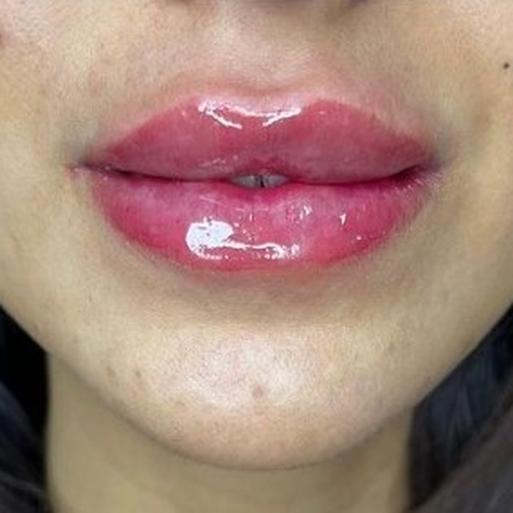Depois - Caso 21 Preenchimento Labial