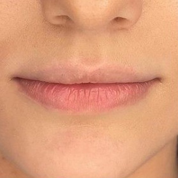 Antes - Preenchimento Labial - Est&eacute;tica Batel Curitiba