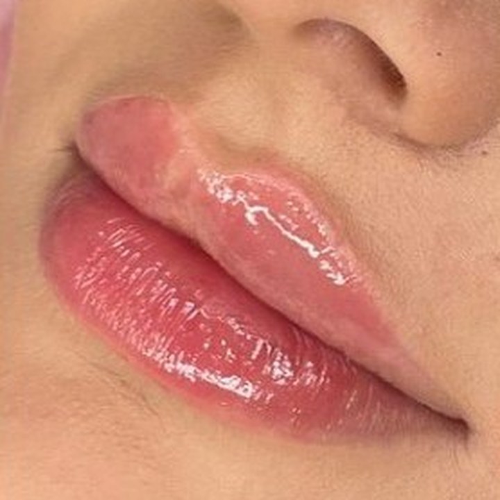 Depois - Preenchimento Labial - Est&eacute;tica Batel Curitiba