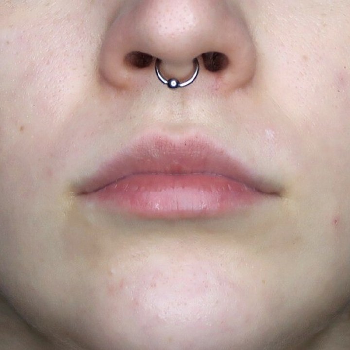 Antes - Caso 23 Preenchimento Labial