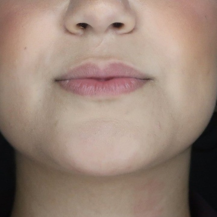 Antes - Caso 24 Preenchimento Labial