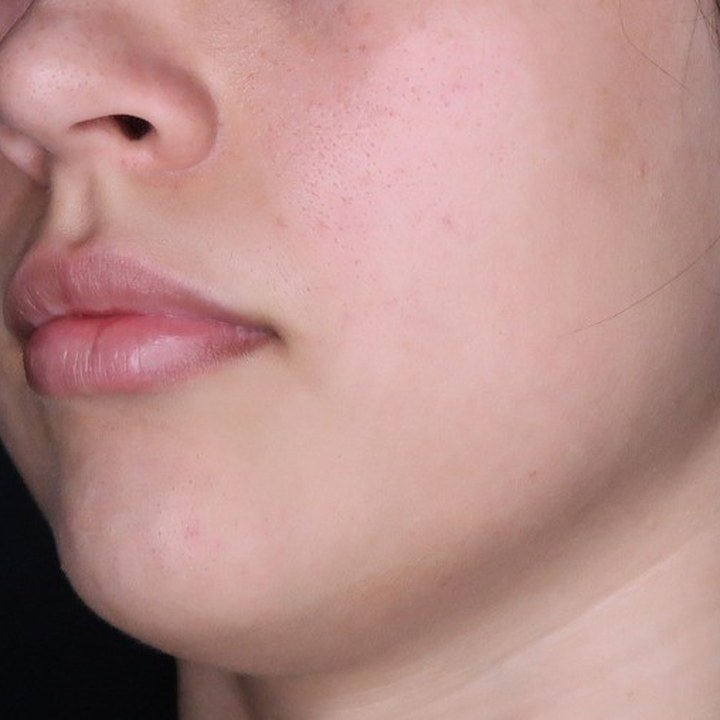 Antes - Preenchimento Labial - Est&eacute;tica Batel Curitiba