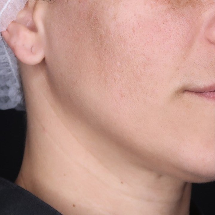 Antes - Preenchimento Labial - Est&eacute;tica Batel Curitiba