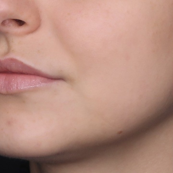 Antes - Preenchimento Labial - Est&eacute;tica Batel Curitiba