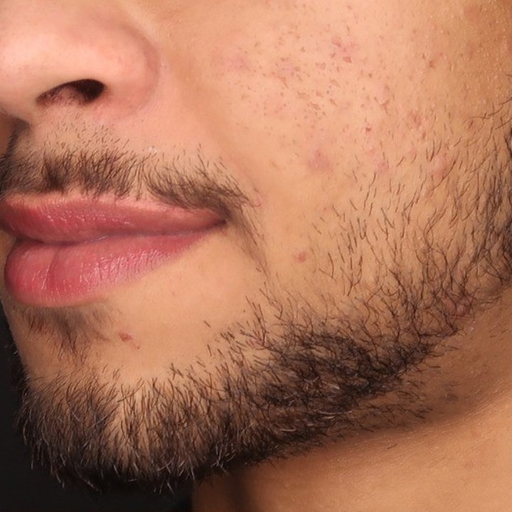 Antes - Preenchimento Labial - Est&eacute;tica Batel Curitiba