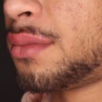 Resultado de preenchimento labial masculino