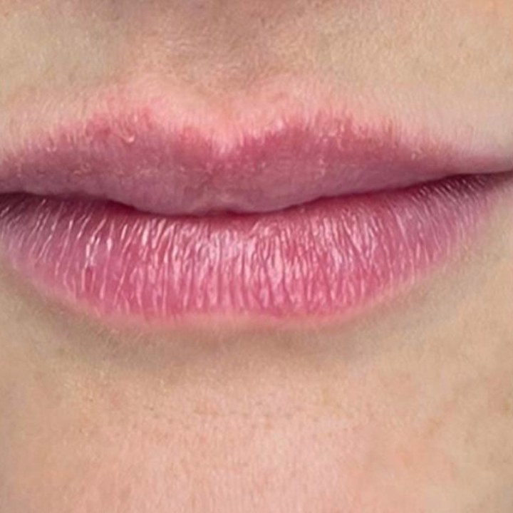 Antes - Caso 03 Preenchimento Labial