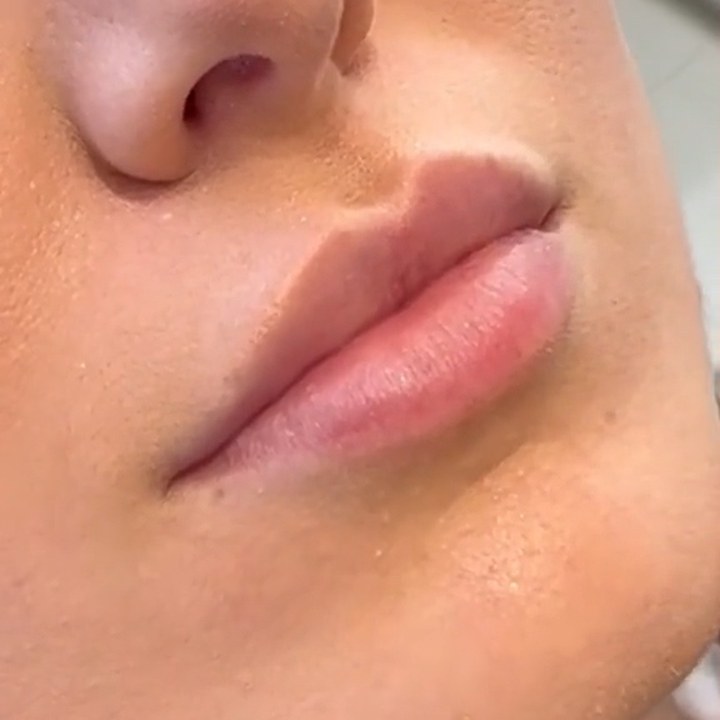 Antes - Caso 30 Preenchimento Labial