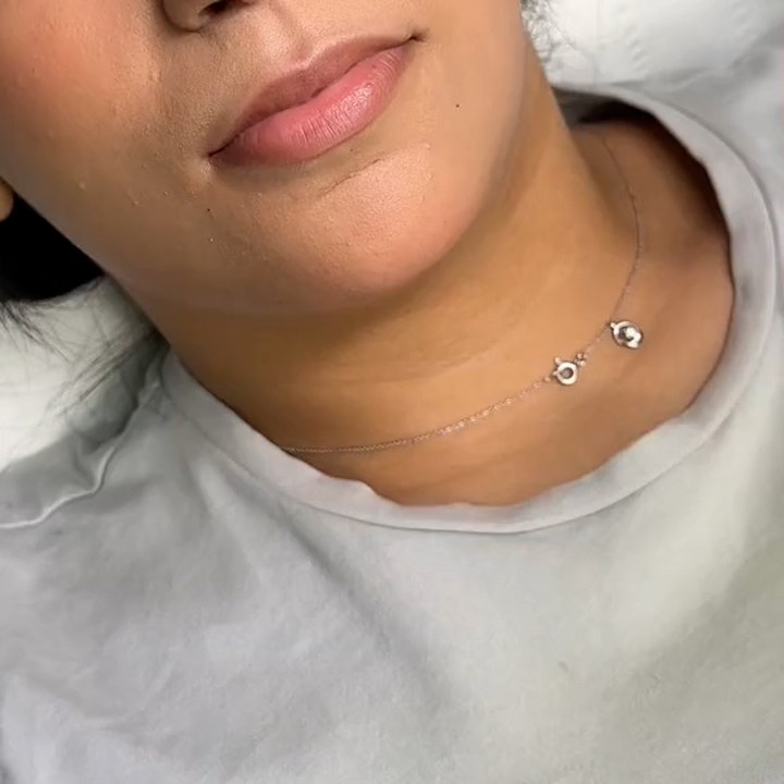Antes - Caso 31 Preenchimento Labial