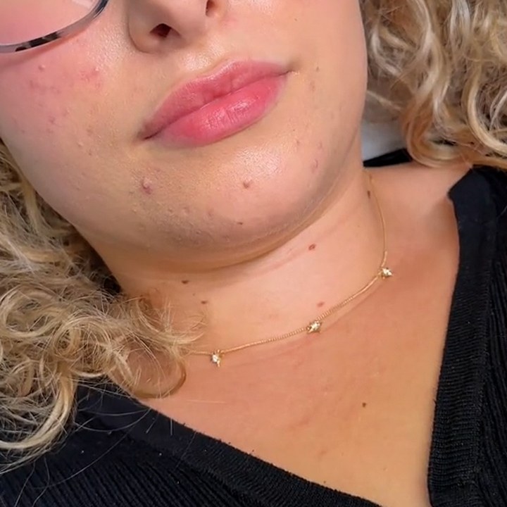 Antes - Caso 32 Preenchimento Labial
