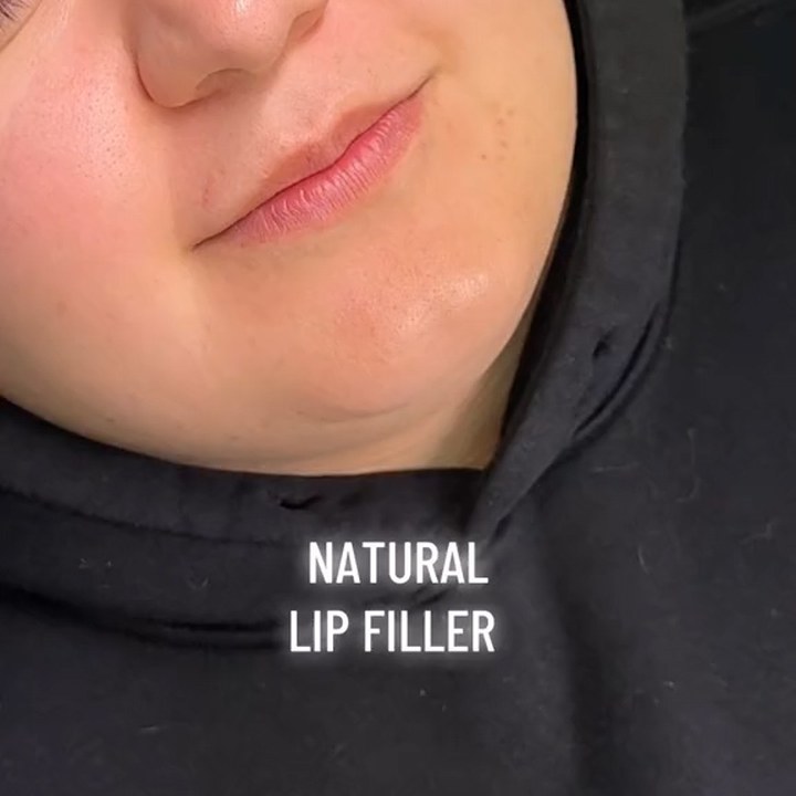 Antes - Preenchimento Labial - Est&eacute;tica Batel Curitiba