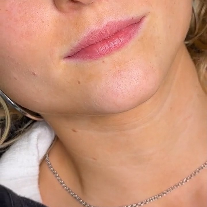 Antes - Caso 34 Preenchimento Labial