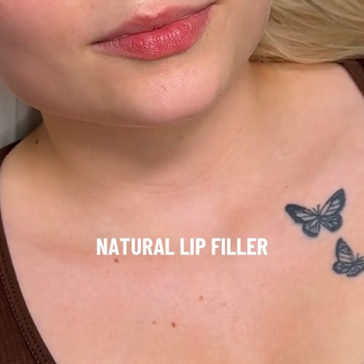 Antes - Caso 35 Preenchimento Labial