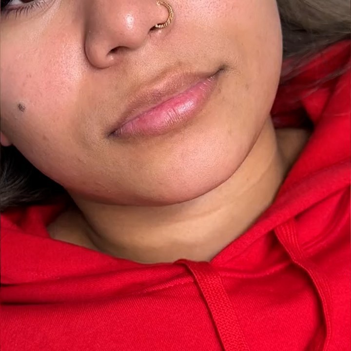 Antes - Preenchimento Labial - Est&eacute;tica Batel Curitiba
