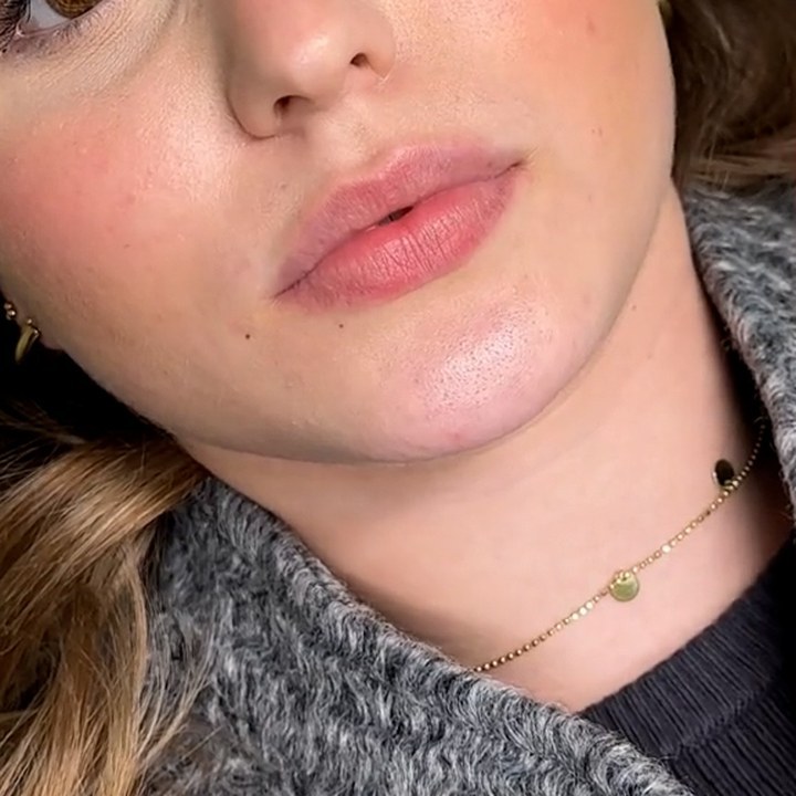 Antes - Preenchimento Labial - Est&eacute;tica Batel Curitiba