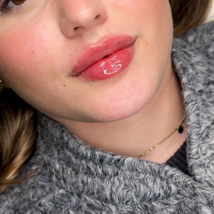 Depois - Preenchimento Labial - Est&eacute;tica Batel Curitiba