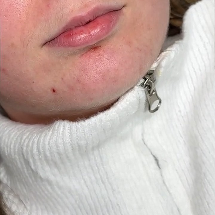 Antes - Preenchimento Labial - Est&eacute;tica Batel Curitiba