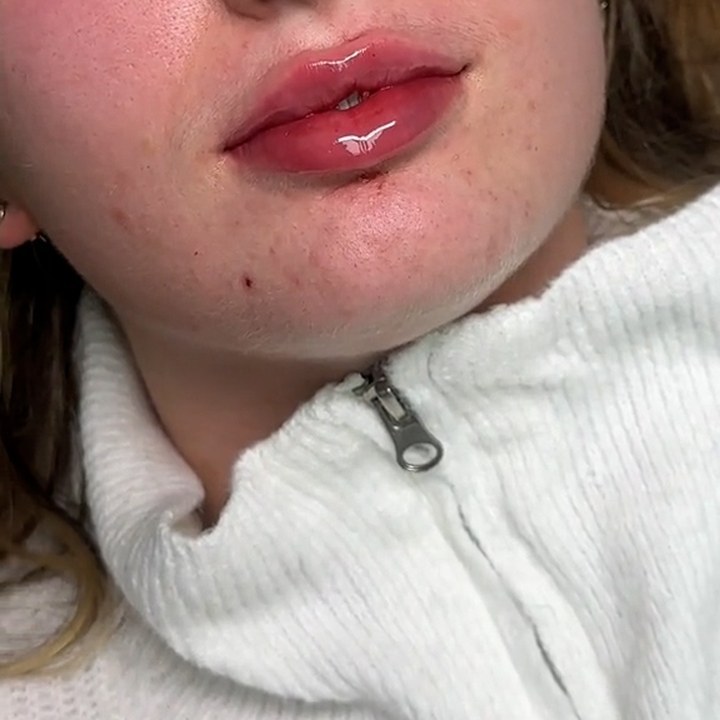 Depois - Preenchimento Labial - Est&eacute;tica Batel Curitiba