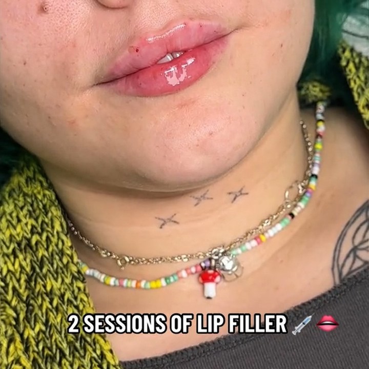 Depois - Caso 39 Preenchimento Labial