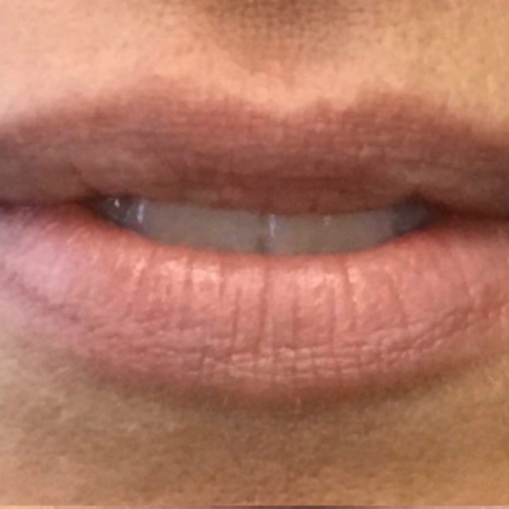 Antes - Preenchimento Labial - Est&eacute;tica Batel Curitiba