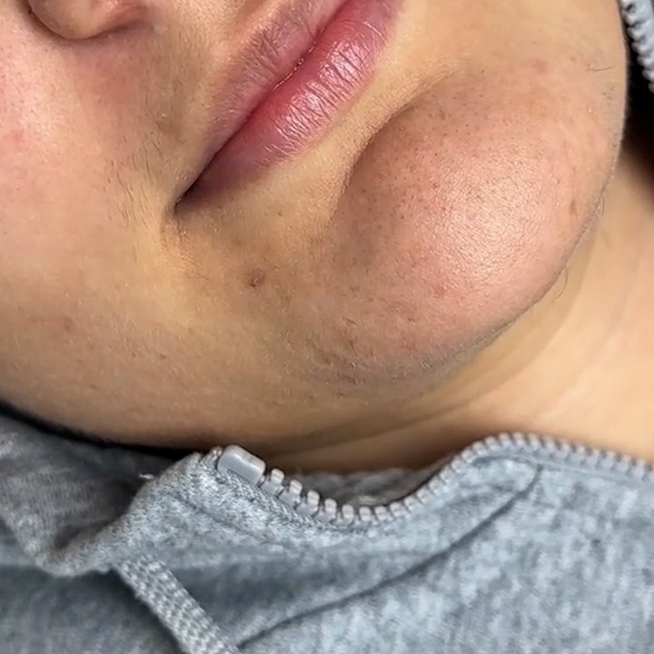 Antes - Preenchimento Labial - Est&eacute;tica Batel Curitiba