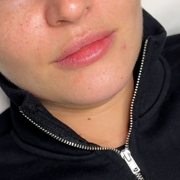 Antes - Preenchimento Labial - Est&eacute;tica Batel Curitiba
