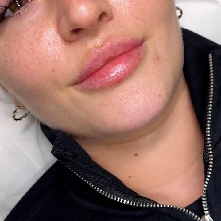 Depois - Preenchimento Labial - Est&eacute;tica Batel Curitiba
