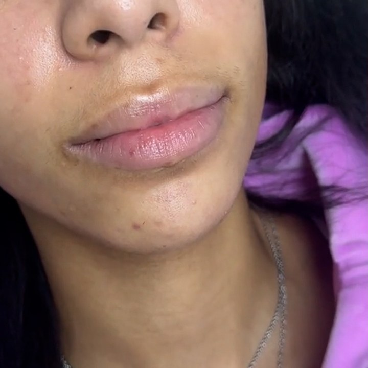 Antes - Caso 42 Preenchimento Labial