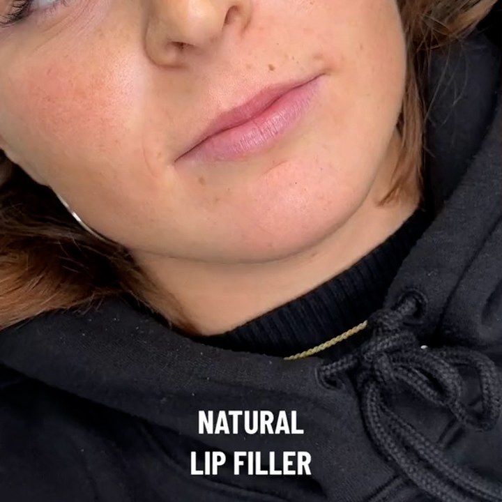 Antes - Caso 43 Preenchimento Labial