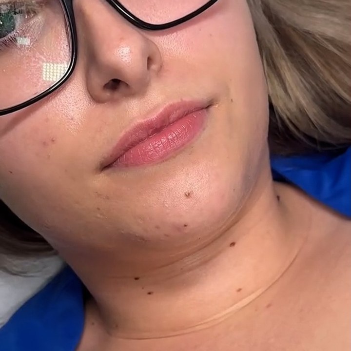 Antes - Caso 44 Preenchimento Labial