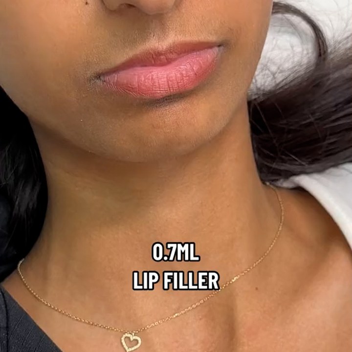 Antes - Caso 45 Preenchimento Labial