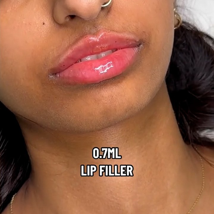 Depois - Caso 45 Preenchimento Labial