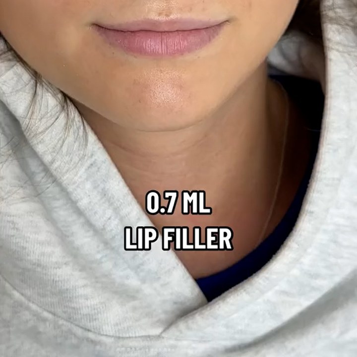 Antes - Preenchimento Labial - Est&eacute;tica Batel Curitiba