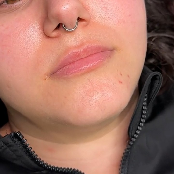Antes - Preenchimento Labial - Est&eacute;tica Batel Curitiba