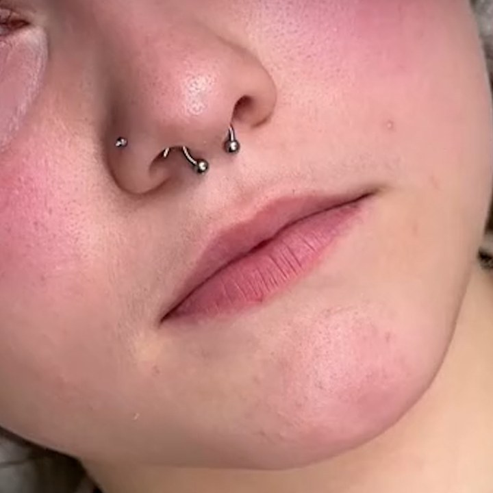 Antes - Preenchimento Labial - Est&eacute;tica Batel Curitiba